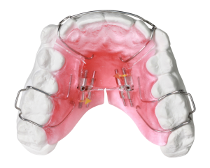 removable orthodontic